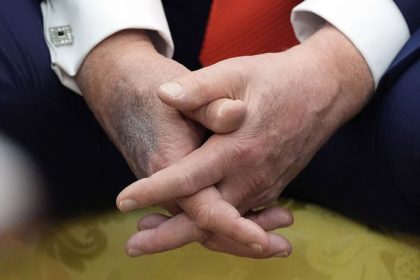 Je v poriadku Trumpove modriny na rukach vyvolavaju obavy