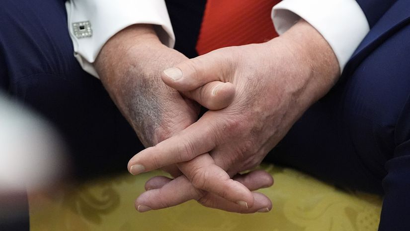 Je v poriadku Trumpove modriny na rukach vyvolavaju obavy